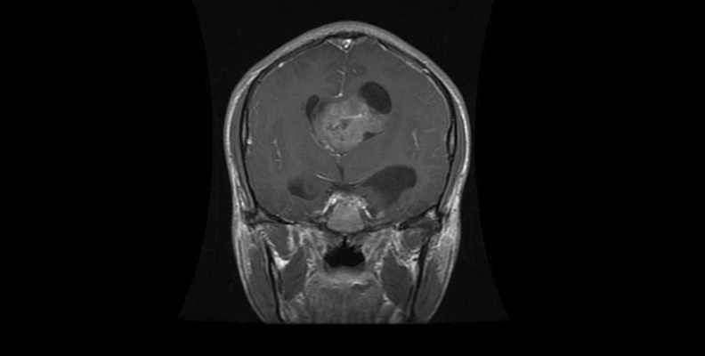 brain-tumor-mri-alexnet thumbnail